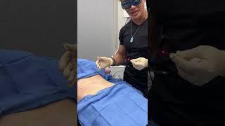 MUFFIN TOP fat melting AND skin tightening treatment with Endolift - Ageless MD