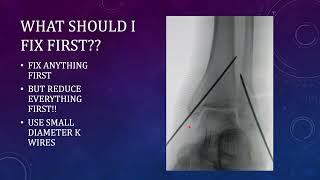 Bimalleolar/Ankle Fractures: Some Tips to Avoid Malalignment