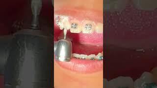 Impacted Canine Braces Treatment - 18 Months of Orthodontic Traction  - Tooth Time Family Dentistry