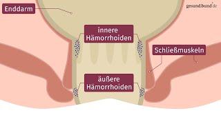 Was sind Hämorrhoiden?