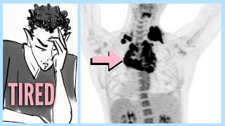 LYMPHOMA After Ignoring 6 WARNING Signs