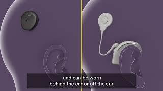 How Cochlear Implants Work