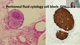 Tip-80; Gliomatosis in the peritoneum and lymph nodes