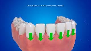 Система Invisalign прозрачная альтернатива брекетам.