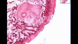 Histopathology Bone--Osteoarthritis, subchondral cyst