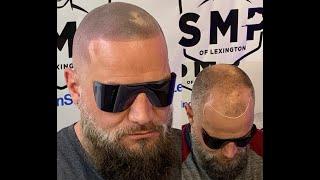 Scalp Micropigmentation SMP hair loss Kentucky