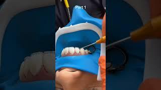 Composite resins restorations #dentist #shorts