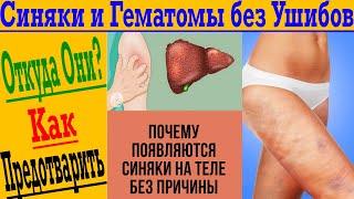 Синяки и гематомы Без ударов и ушибов! Откуда они и как предотвратить?!