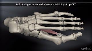 Hallux Valgus Repair with the Metal Mini TightRope® FT