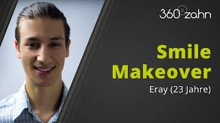 Veneers vorher nachher. Zahnkorrektur mit Veneers - Smile Makeover von Eray bei  360°zahn