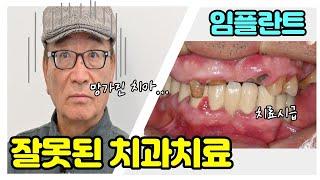 이천 임플란트 / 과거 잘못된 치과 치료로 치아가 빠진사연