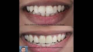 Smile Makeover for cosmetic dental problems  by Cosmetic Dentist Dr Trivikram