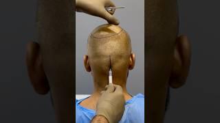 UMWERFENDE Haartransplantation | Neueste FUE-Technik #shorts #viral #hair