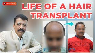 Life of Hair Transplant | Is Hair Transplant Permanent | Causes & Precautions | By Dr Arvind Poswal