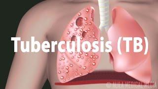 Tuberculosis (TB): Progression of the Disease, Latent and Active Infections.