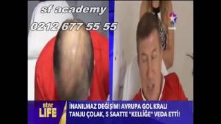 SAÇ SİMÜLASYONUNDA İNANILMAZ DEĞİŞİM- ÖNCESİ SONRASI GÖRÜNTÜLERİ (ŞADİ & FİLİZ ÜSTÜNDAĞ )