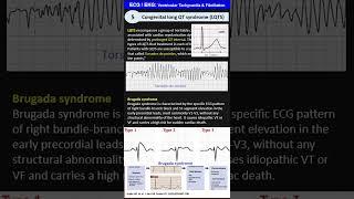 ECG / EKG 5: Ventricular Tachycardia, Ventricular Fibrillation, Ventricular Flutter, Torsades de..