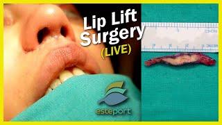 Lip Lift Surgery Live #liplift