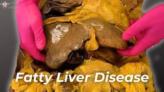 Is Your Liver in Danger? Understanding Fatty Liver Disease