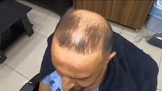 Skin Fade Haircut And Hairfiber Amazing Transformation #hairfiber #transformation