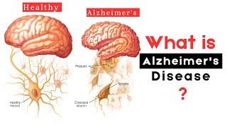 what is Alzheimer's disease ?