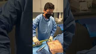 Removal of Subcutaneous Fat from Abdomen