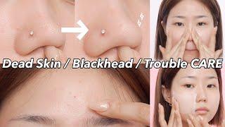 Blackhead / Skin Troubles / Deadskin Care products I really use and love ︎ recommendations | how to