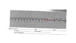 Atrial & Junctional Homework Review video