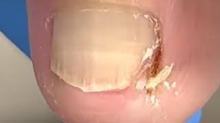 The patient's ingrown nails were wrongly trimmed! leave huge nails【Xue Yidao】