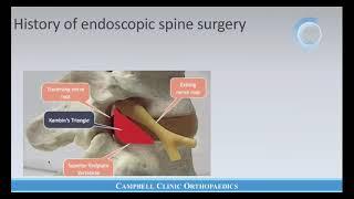 Endoscopic Spine Surgery - Why Bother?  Featuring Dr. Raymond Gardocki