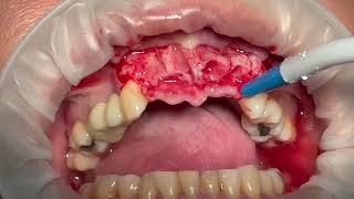 Upper anterior Immediate Loading of Dental Implants - Incisor Teeth