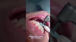 This is how we do it  #bonding #composite #teeth #dentist #dentistry #contouring #teethwhitening