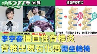 李宇春僵直性脊椎炎 脊椎出現石化感需坐輪椅 健康2.0