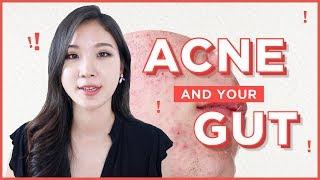 How To Treat Acne from the Inside Out • Acne and Gut health