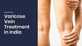 Varicose Vein Treatment in India | Varicose Vein Cost Treatment in India