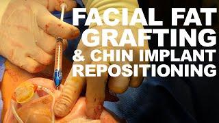 Facial Fat Grafting & Chin Implant Repositioning- Dr. Paul Ruff | West End Plastic Surgery