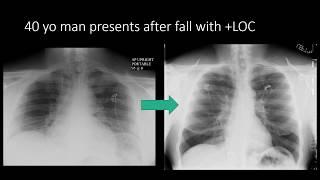 Enlargement of the Mediastinum