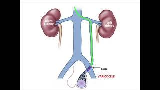 Varicocele Embolisation Delhi