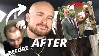 BALDING TO BALD GLOW UPS - THE ULTIMATE TRANSFORMATIONS - Part 1