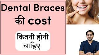 Cost of teeth braces | दांतों के ब्रेसिज़ का खर्च | Dental Braces price in Indore