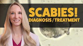 SCABIES: DIAGNOSIS, TREATMENT, CAUTIONARY TIPS from a Dermatologist