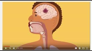 Swallowing and Communication after Stroke