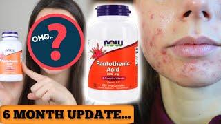 I TOOK PANTOTHENIC ACID FOR 6 MONTHS.. HERE IS THE UPDATE. || Did B5 get rid of cystic acne fast?