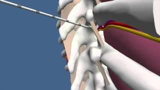 Techniques for Thoracic Paravertebral Block (TPVB)