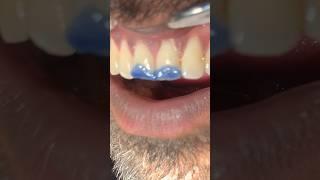 Smoking cause stains ruined smile #dental #dentistry #viral #youtube#umairtoothfairy⁠@Umairazeem8553