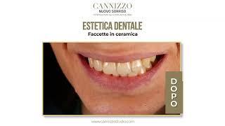 Interventi Estetica Dentale e Implantologia - Studio Cannizzo