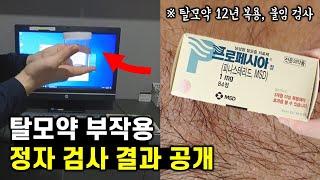 탈모약 복용 12년, 정자 검사를 받고 왔습니다.. (불임검사, 탈모약 부작용)