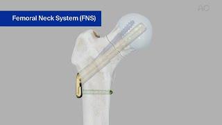 Femur, Neck—Fracture 31B—Stabilization Using the Femoral Neck System FNS