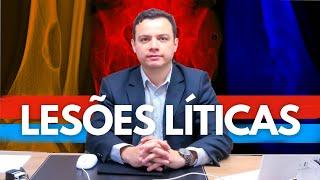 Lesões Líticas. O que é uma lesão lítica?