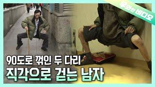 양쪽 다리가 직각으로 굳은 채 평생을 살아온 남자┃A Man Who's Been Living With His Legs Stiff at Right Angles